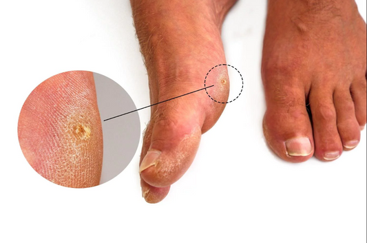 Foot Corn Removal Walkthrough by Podiatrist 