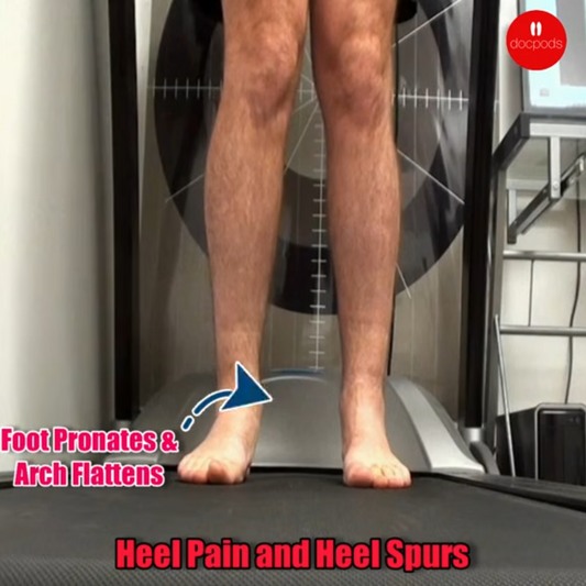 "Dealing with heel pain? Discover the secret to relief and say goodbye to heel spurs & pronation!