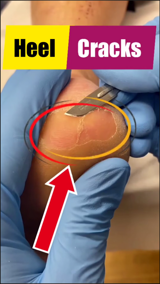 Transforming rough heels into smooth beauties! 😍✨ Watch the magic of callus removal unfold