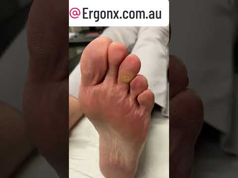 Satisfying Corn Removal from Toe Transformation #FootCare #Podiatry