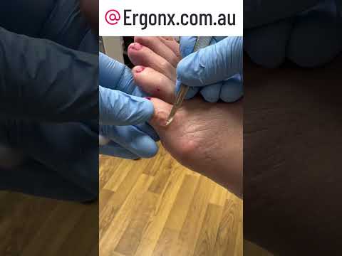 Oddly Satisfying Corn Removal from Little Toe by Expert Podiatrist #FootCare #Satisfying