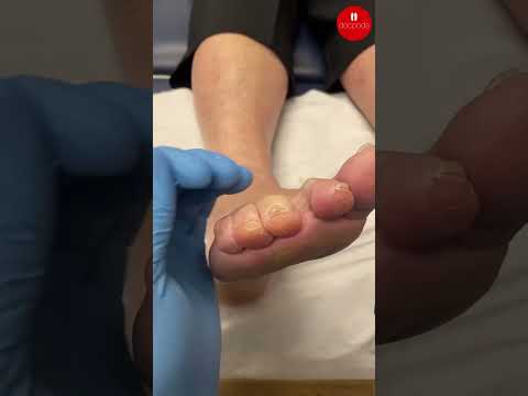 Apex Callus Removal on Lesser Toes Explained