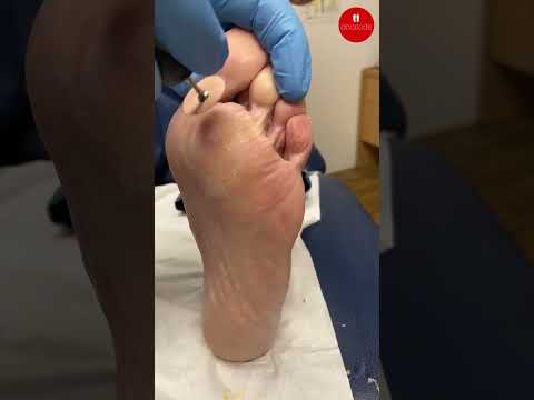How Podiatrists Sand Forefoot Calluses Safely
