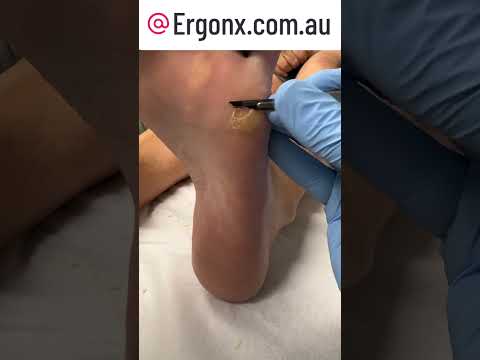 Satisfying Foot Corn Removal by Podiatrist with Scalpel #CornRemoval #Podiatry
