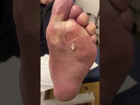 Transform your feet with this satisfying callus removal! 🦶✨ Witness the magic of scalpel precision