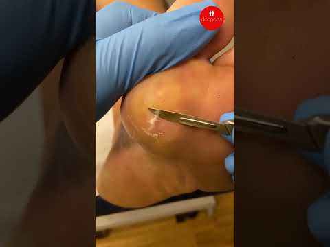 Plantar Wart Debridement: What to Expect