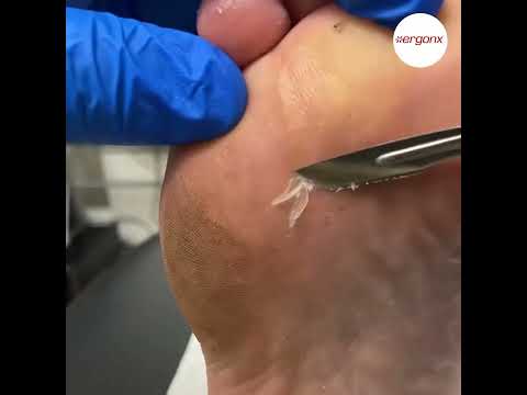 Foot Calluses and Corns: Causes and Safe Care