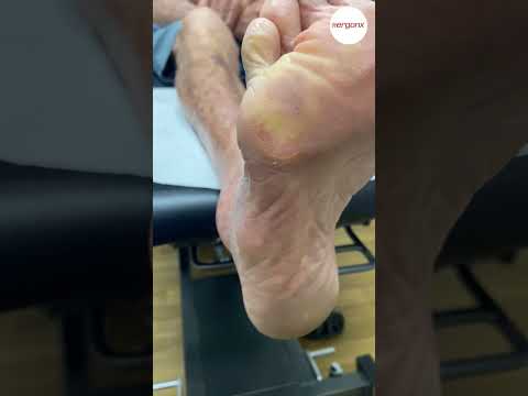 Painful Foot Corns: Safe Care and Infection Signs