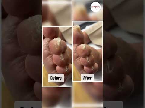 Toe Corns from Tight Shoes: Fit and Care Tips