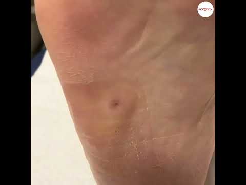 How Severe Foot Corns Are Treated by Podiatrists