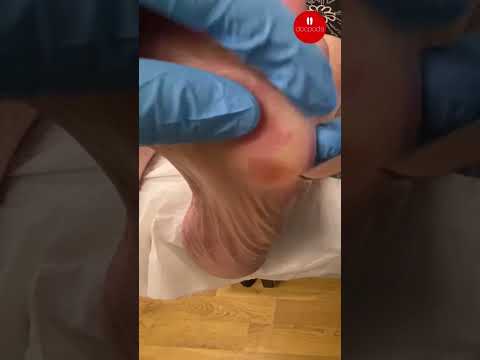 Painful Foot Corns: Professional Podiatry Care