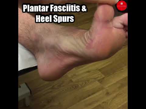 Discover the secret to conquering foot pain! 🌿 Say goodbye to plantar fasciitis and heel spurs with