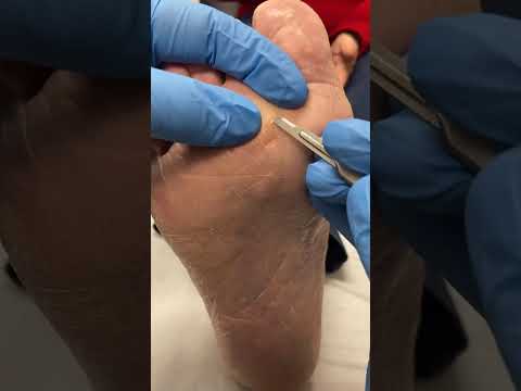 Ultimate Seed Corn Removal: Podiatrist's Painful Yet Satisfying Procedure Revealed