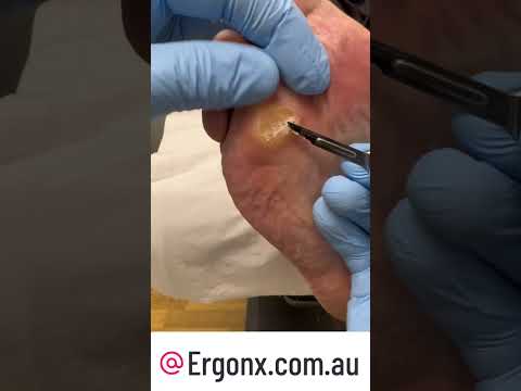 Satisfying Corn & Callus Removal by Podiatrist ASMR Foot Care #Podiatry #FootHealth