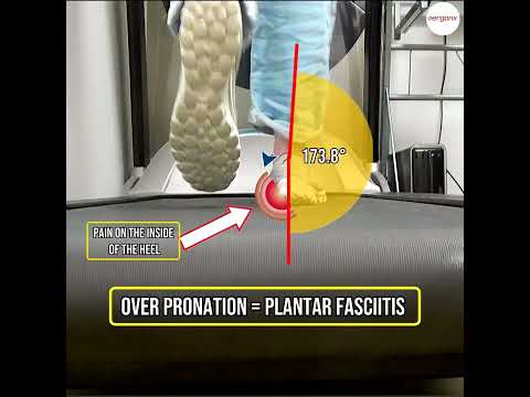 Overpronation and Foot Discomfort: What to Know
