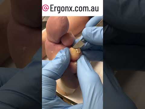 Satisfying Slow Motion Callus Removal on Toe #CallusCare #FootHealth