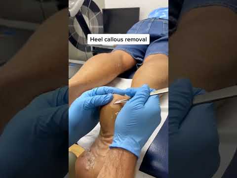 Watch this satisfying heel transformation! Say goodbye to painful cracked heels and hello to smooth,