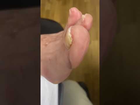 Watch as a skilled podiatrist removes corn between toes for pain relief and smoother steps! 👣✨