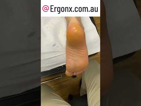 Amazing Extreme Heel Callus Removal by Expert Podiatrist ASMR #Satisfying #CallusRemoval
