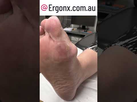 Podiatry Clinic: Satisfying Foot Callus Removal! #Podiatry #FootCare
