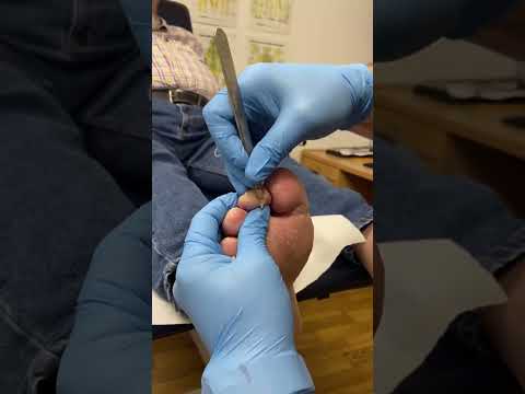 Transforming your health step by step! Watch as we expertly tackle a toe ulcer, improving comfort