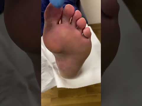Say goodbye to foot pain! Discover the ultimate solution for corn on your forefoot and step into