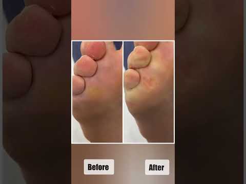 Aussie Podiatrist's Satisfying Callus Removal | Watch the Transformation #Podiatry #CallusCare