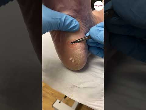 Ultimate Dry Heel Callus Removal at Podiatry Clinic #FootCare #CallusTreatment