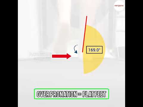 Overpronation and Flat Feet: Support Options