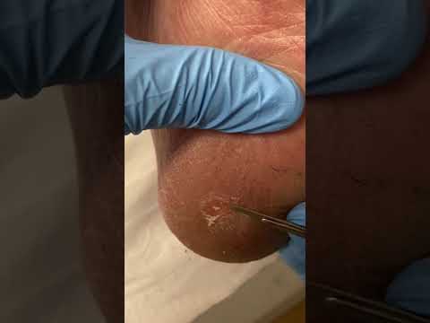 Bye-bye heel pain! Watch a satisfying corn removal that’ll make you feel relief just by watching