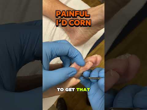 Painful corn between the toes? This is why