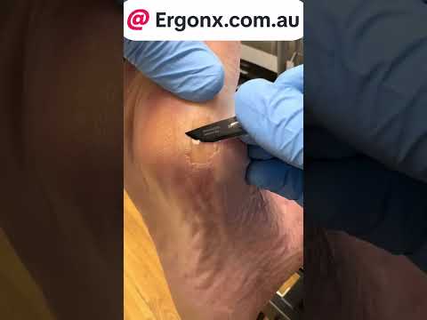 Work-Related Calluses: Professional Foot Care