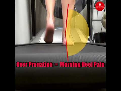Overpronation and Morning Heel Pain: What to Know