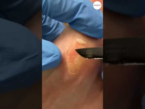 Ultimate Plumber Foot Transformation: Thick & Dry Skin Removed #FootCare #Satisfaction