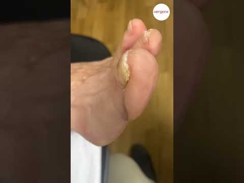 Toe Corns and Work Boots: Fit and Care Tips