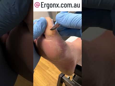 Ultimate Big Toe Callus Removal for Painful Feet in Safety Boots #FootCare #CallusRemoval
