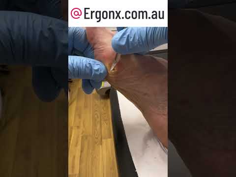 Bunion Joint Callus Removal Inside Look at a Podiatry Clinic #Podiatry #BunionCare