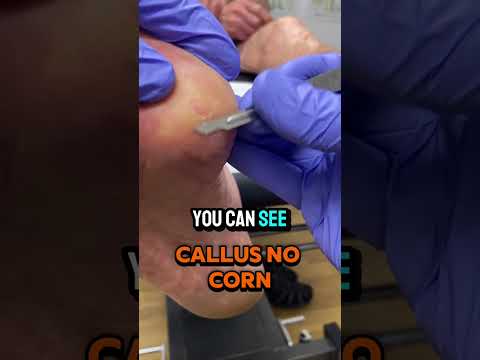 Sometimes corns can look really bad — thick, yellow, and built up — but that doesn’t always mean