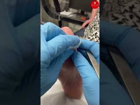 Say goodbye to stubborn big toe calluses! Watch as we transform feet with our incredible removal