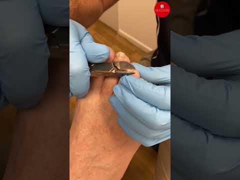 Trimming Thick Fungal Toenails Safely | Podiatry Care
