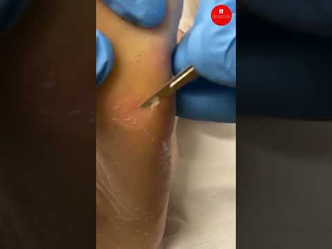 Rough Foot Calluses: Podiatry Care Explained