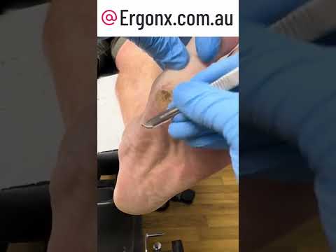 Beat the Pain: Fix Calluses from Your Worn Out Work Boots #FootCare #DIYFix
