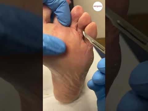 Say Goodbye to Corns Fast: Effective Podiatry Clinic Treatment #FootCare #Podiatry