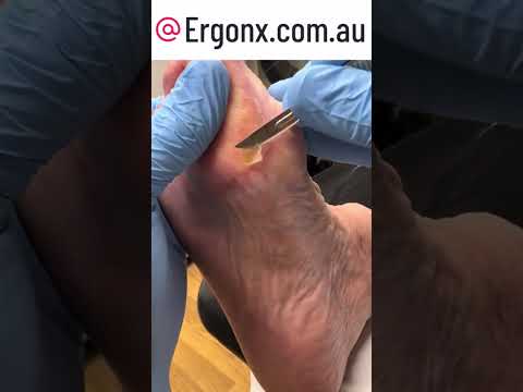 Ultimate Callus Removal by Podiatrist: Hard-Working Feet Transformation #Podiatry #FootCare
