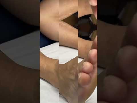 🌽👣 Ever had a corn on your little toe? It’s not fun, but let's make it funny! Watch my struggle &