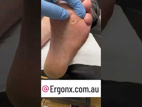 Ultimate Foot Corn Cutting Satisfaction ASMR #Podiatry #FootCare – Ergonx