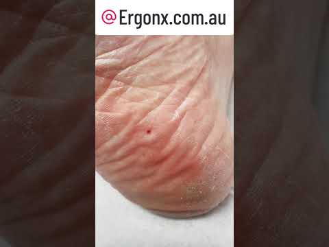 Satisfying Corn Cutting by Podiatrist - Relaxing Foot Care ASMR #FootSatisfaction #Podiatry