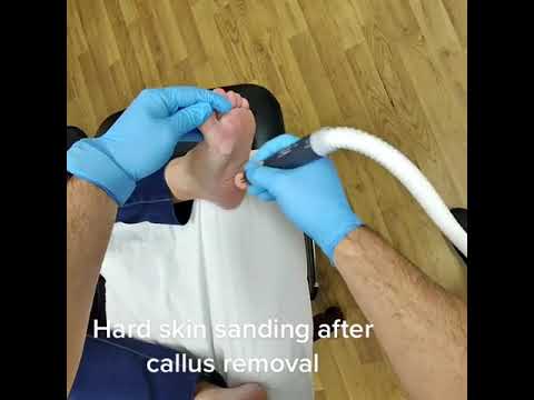 ✨Transform your feet from rough to radiant!✨ Check out this satisfying #HardSkinSanding after a