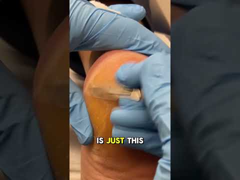 Managing Heel Calluses in Tradies | Podiatry Care
