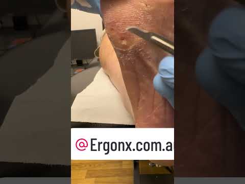 Satisfying Corn Removal by Expert Podiatrist in Australia #FootCare #Podiatry